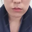 骨切り（あご） / 脂肪吸引（顔） / ボトックス（エラ・小顔） 銀座マイアミ美容外科 BEFORE サムネイル用