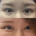 目頭切開 / 蒙古ひだ形成 / 目元修正 イブ整形外科 BEFORE サムネイル用