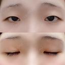二重埋没 湘南美容クリニック 赤坂見附院 BEFORE サムネイル用
