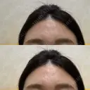 額を丸く / シワ取りボトックス 銀座3丁目・BANNAI美容クリニック BEFORE サムネイル用