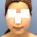 糸リフト / バッカルファット除去 / 脂肪吸引（顔） / ボトックス（エラ・小顔） 湘南美容クリニック 秋葉原院 BEFORE サムネイル用