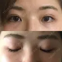 二重切開 / 眼瞼下垂（切開） / 目尻切開 ジュエリー美容外科 BEFORE サムネイル用