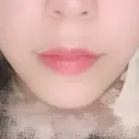 人中短縮 / PRP皮膚再生療法 BIANCA銀座 BEFORE サムネイル用