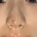 小鼻縮小（切開） / スレッドノーズ / ヒアルロン酸注入（鼻） キップン整形外科 BEFORE サムネイル用