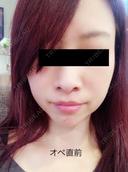 切開リフト GENIUS(ジーニアス)美容外科・皮膚科（旧：4ever美容外科・皮膚科 釜山 西面店） BEFORE サムネイル用