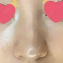 鼻尖形成（切開） / 小鼻縮小（切開） / 軟骨移植 湘南美容クリニック 大阪心斎橋院 BEFORE サムネイル用