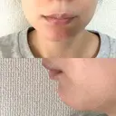 ボトックス（あご） PICO BEAUTY CLINIC BEFORE サムネイル用