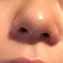 鼻尖形成（切開） / 軟骨移植 白山クリニック 大分 BEFORE サムネイル用