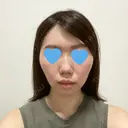 脂肪溶解注射（顔） 赤坂プレミアクリニック BEFORE サムネイル用