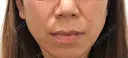 人中短縮 銀座アテナクリニック BEFORE サムネイル用