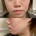ボトックス（エラ・小顔） 湘南美容クリニック 川崎院 BEFORE サムネイル用