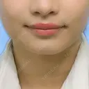 ヒアルロン酸注入（あご） / その他（輪郭） 東京形成美容外科 船橋院 BEFORE サムネイル用