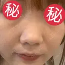 小鼻縮小（切開） / ヒアルロン酸注入（鼻） 東京形成美容外科 船橋院 BEFORE サムネイル用