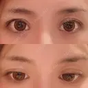 二重切開 / 眼瞼下垂（切開） / 目元修正 シエルクリニック BEFORE サムネイル用