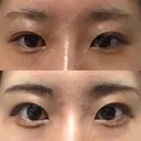 目尻切開 / タレ目形成・グラマラスライン（切開） A CLINIC（エークリニック） 銀座院 BEFORE サムネイル用