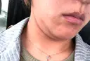 その他（ボディ） 肌と歯のクリニック 東京ベイ幕張 BEFORE サムネイル用