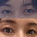二重埋没 城本クリニック 立川院 BEFORE サムネイル用