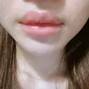 口唇縮小術 くさのたろうクリニック BEFORE サムネイル用