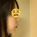 ヒアルロン酸注入（あご） 植村美容外科 BEFORE サムネイル用
