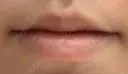アートメイク（唇） LETICIA CLINIC（レティシア クリニック） BEFORE サムネイル用