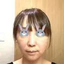 切開リフト 石倉クリニック 水戸院 BEFORE サムネイル用