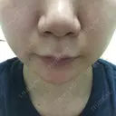 鼻尖形成（切開） / ヒアルロン酸注入（鼻） 東京ヒルズクリニック 新宿院 BEFORE サムネイル用