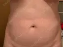その他（ボディ） 湘南美容クリニック 仙台院 BEFORE サムネイル用