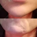 ボトックス（あご） 品川美容外科 仙台院 BEFORE サムネイル用