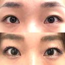 二重切開 / 目頭切開 心斎橋コムロ美容外科クリニック BEFORE サムネイル用