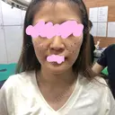 スレッドノーズ / その他（肌） キップン整形外科 BEFORE サムネイル用