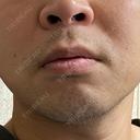 医療脱毛（顔） 自由が丘クリニック BEFORE サムネイル用