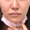 その他（肌） A CLINIC（エークリニック） 横浜院 BEFORE サムネイル用