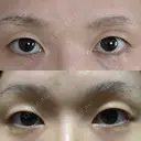 二重切開 よだ形成外科クリニック BEFORE サムネイル用