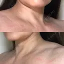 ボトックス（肩） 湘南美容クリニック 奈良院 BEFORE サムネイル用