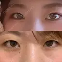 二重埋没 R.O.clinic BEFORE サムネイル用