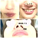 鼻中隔延長（切開） / 軟骨移植 / 鼻修正 / 傷跡修正 神戸大学附属病院 美容外科 BEFORE サムネイル用