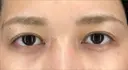 蒙古ひだ形成 R.O.clinic BEFORE サムネイル用