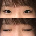 二重埋没 / ヒアルロン酸注入（涙袋） ルラ美容クリニック 新宿院 BEFORE サムネイル用