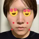 脂肪溶解注射（顔） 赤坂プレミアクリニック BEFORE サムネイル用