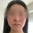 脂肪吸引（顔） / 輪郭修正 / 切開リフト / その他（輪郭） ドクターゴールドマンクリニック 東京高輪院 BEFORE サムネイル用