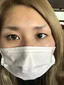 二重切開 GLANZ CLINIC BEFORE サムネイル用