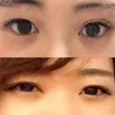 二重埋没 城本クリニック 大阪院 BEFORE サムネイル用