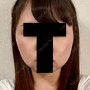 脂肪溶解注射（顔） 赤坂プレミアクリニック BEFORE サムネイル用