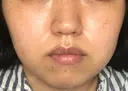 シミ取りレーザー / ピコレーザートーニング（美白・肝斑） UB CLINIC銀座 BEFORE サムネイル用