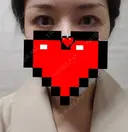 眉下切開 エイペックス美容外科 BEFORE サムネイル用