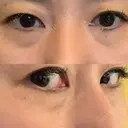 クマ治療 / 下まぶたたるみ取り / 下まぶたの脂肪取り 品川美容外科 渋谷院（※品川スキンクリニック提携） BEFORE サムネイル用