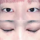 二重切開 松下皮フ形成外科 BEFORE サムネイル用