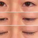 二重埋没 / 上まぶたの脂肪取り / その他（目元） 東京形成美容外科 船橋院 BEFORE サムネイル用