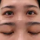 上まぶたの脂肪取り / 眉下切開 WOM CLINIC GINZA （ワム クリニック ギンザ） BEFORE サムネイル用