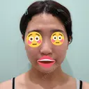 糸リフト / バッカルファット除去 / 脂肪吸引（顔） / ボトックス（エラ・小顔） WOM CLINIC GINZA （ワム クリニック ギンザ） BEFORE サムネイル用